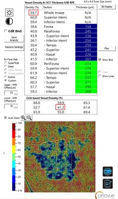OCT angiography analysis of choriocapillaris vascular density in different stages of age-related macular degeneration